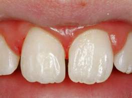 Case 3 Accident Rebuild After