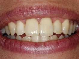 Case 4 Crown Replacement After