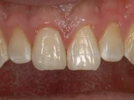 Case 5 Broken Tooth After