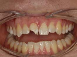 Case 5 Broken Tooth Before