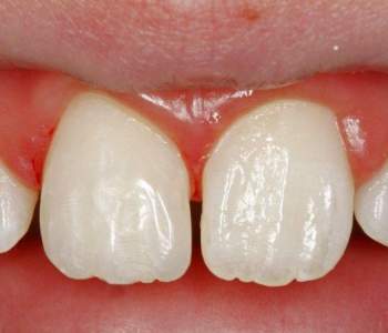 Case 3 Accident Rebuild After