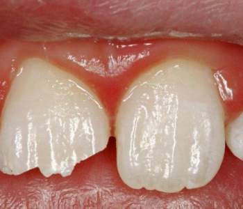 Case 3 Accident Rebuild Before