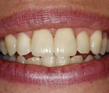 Case 4 Crown Replacement After