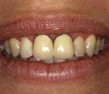 Case 4 Crown Replacement Before