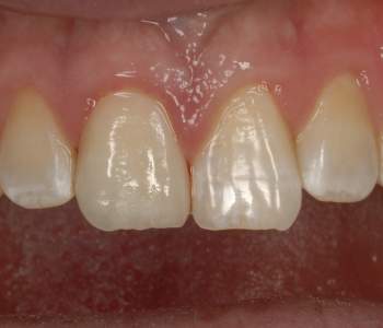 Case 5 Broken Tooth After