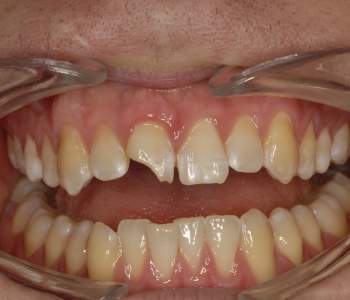 Case 5 Broken Tooth Before